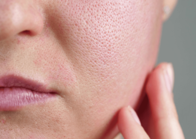 A Macro Look at Microneedling