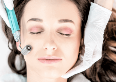 Microneedling for Acne Scarring