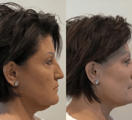 Homepage Before and After Turkey Neck Treatment