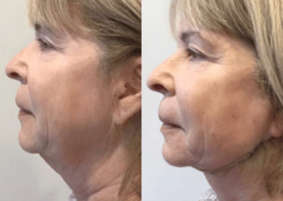 PRP injections for your face can make a real difference in the appearance of wrinkles, fine lines, and even scarring.