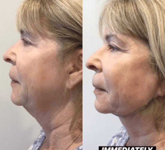 Homepage Before and After Jawline Surgery