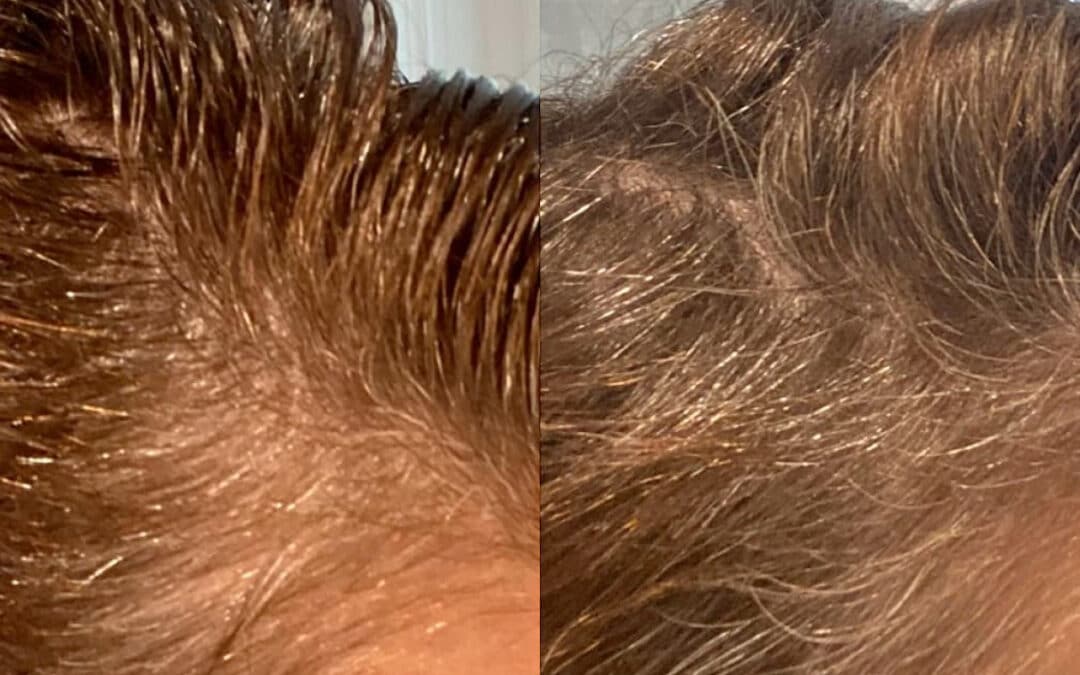 Hair Restoration to Treat Thinning Hair