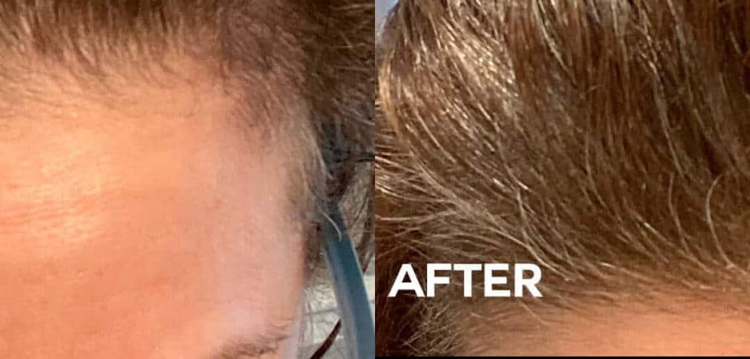 Hair Restoration to Promote Hair Growth