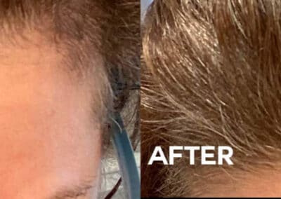 Hair Restoration to Promote Hair Growth