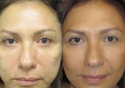 Injectable Treatments for A Youthful Appearance