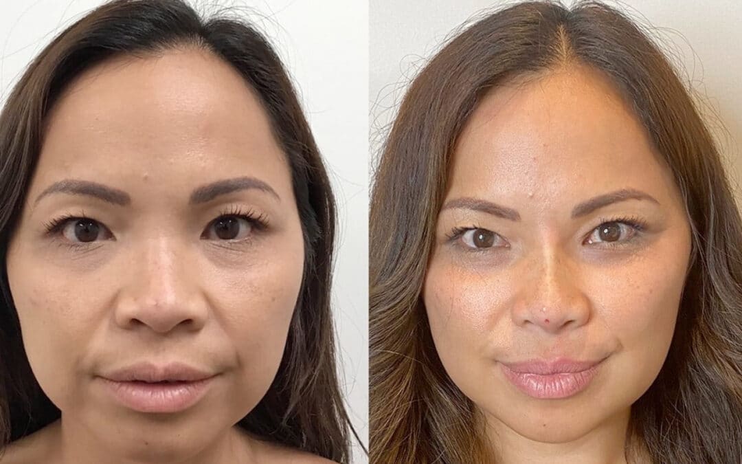 Injectables to Contour the Midface and Define the Jawline