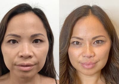 Injectables to Contour the Midface and Define the Jawline