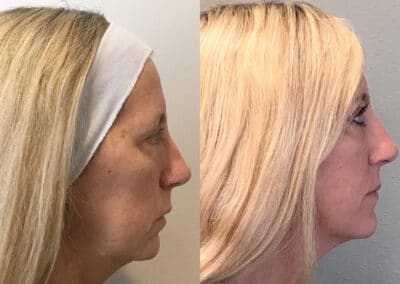 Threadlifts are cutting edge cosmetic surgery procedures that can give you similar results as a facelift without the invasive surgery.