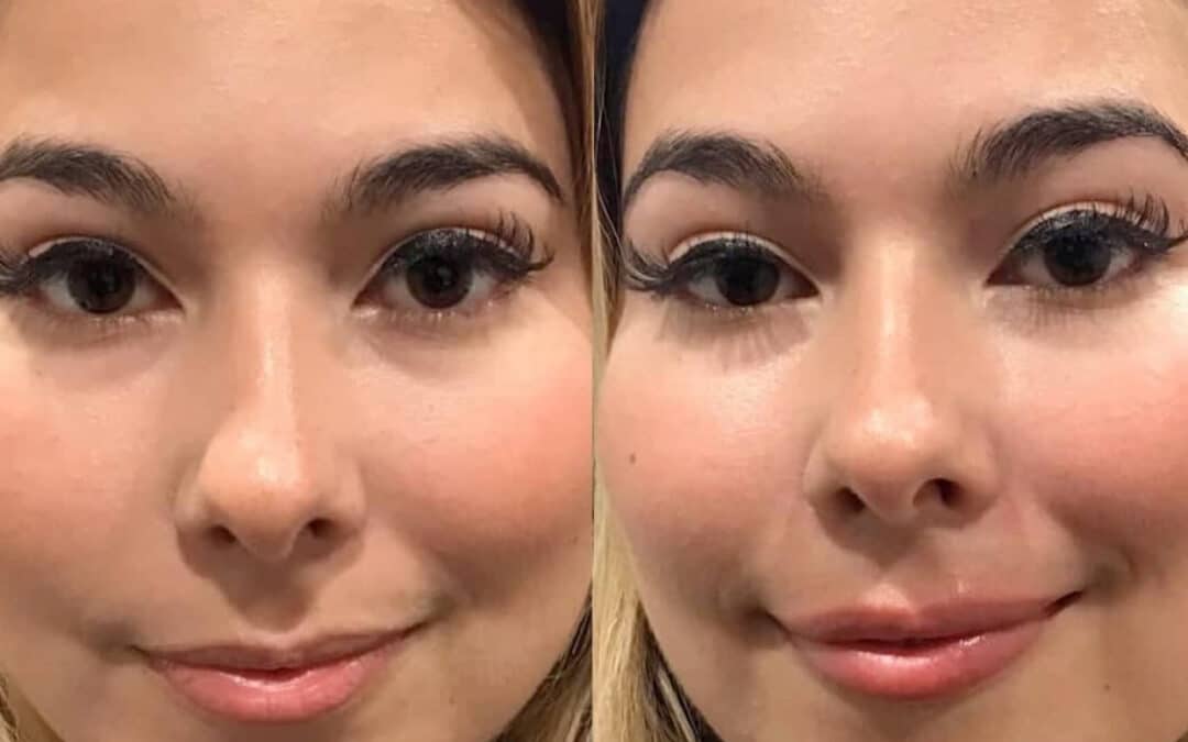 Lip Injections for A Balanced Smile