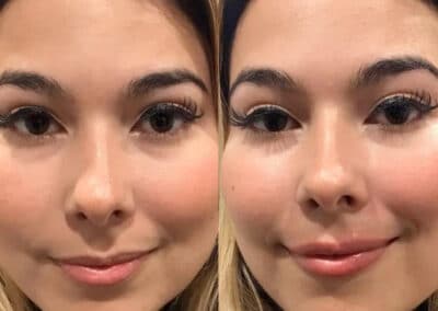 Lip Injections for A Balanced Smile