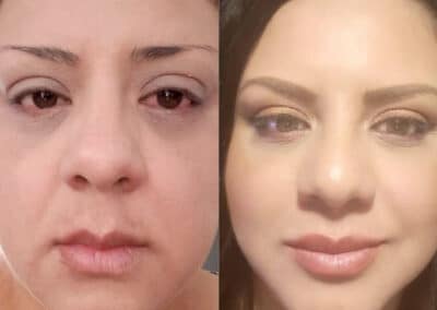Lip Injections for Fuller Lips
