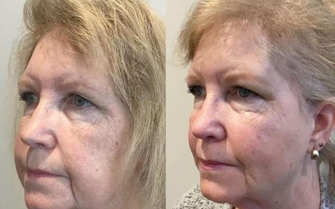 Thread Lift Treatment to Enhance the Midface and Jawline