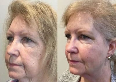 Thread Lift Treatment to Enhance the Midface and Jawline