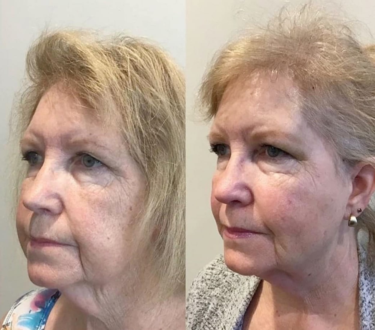 We can't stop the aging process but Dr. Jennifer Armstrong can perform wrinkle correction procedures that reduce the signs of aging.