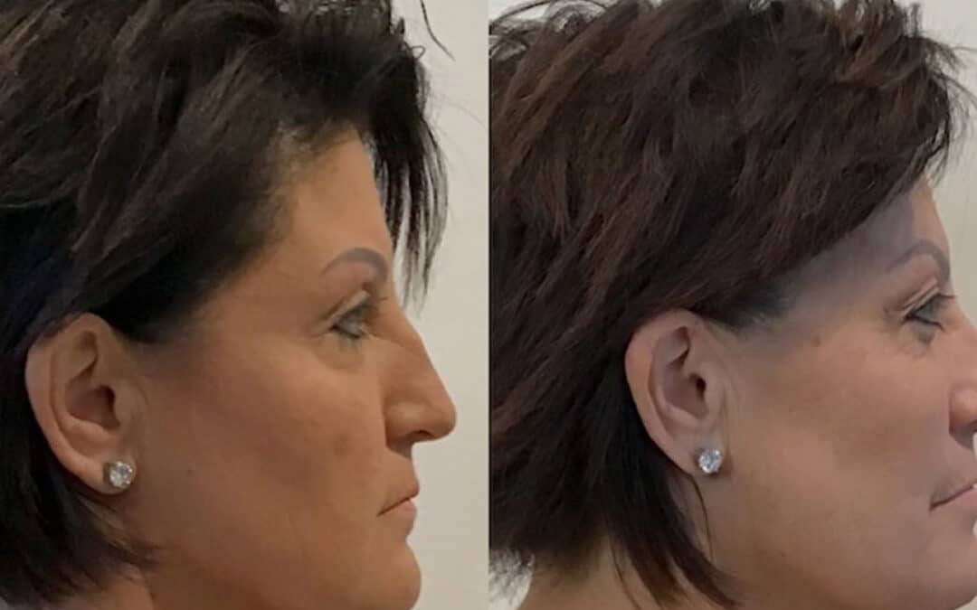 Thread Lift to Improve the Midface