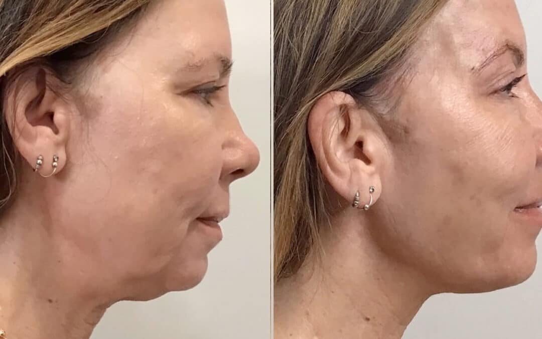 Thread Lift to Tighten the Midface and Jawline