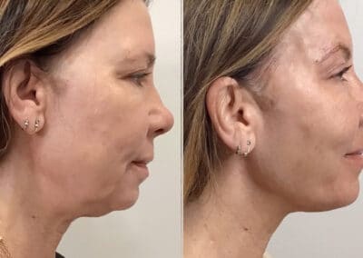 Thread Lift to Tighten the Midface and Jawline