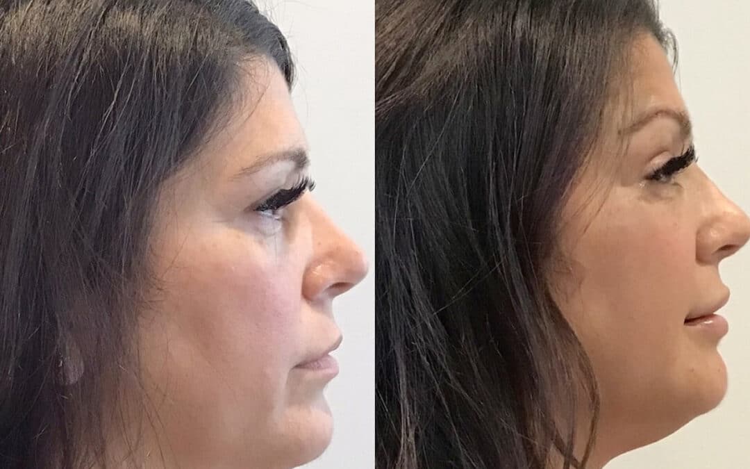 Thread Lift to Tighten the Jawline