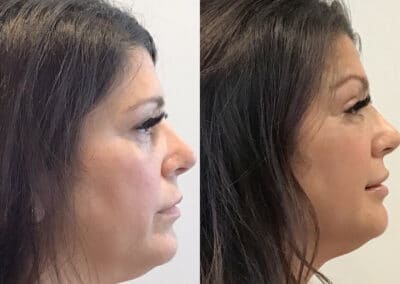 Thread Lift to Tighten the Jawline