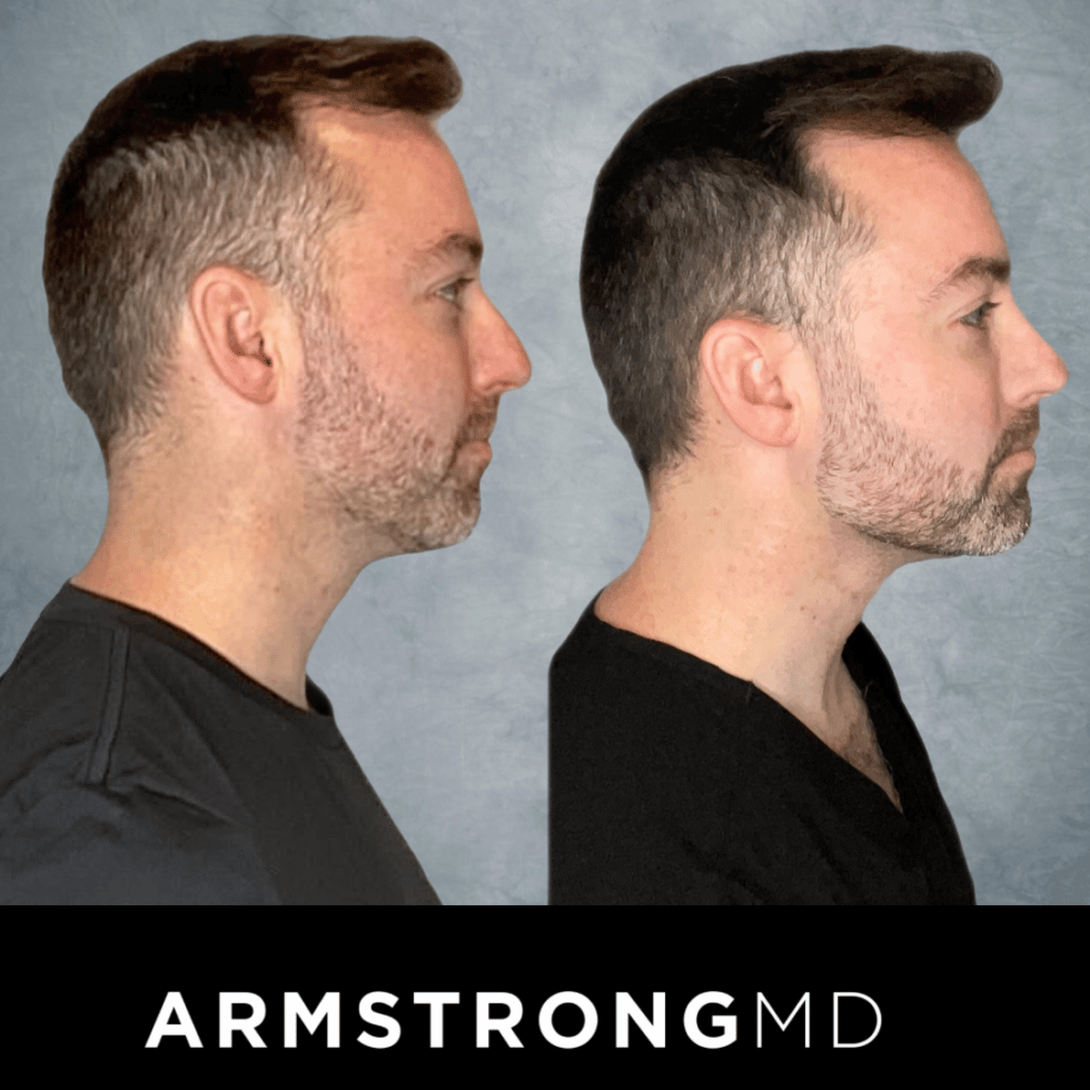PRP Therapy Newport Beach, CA Armstrong MD