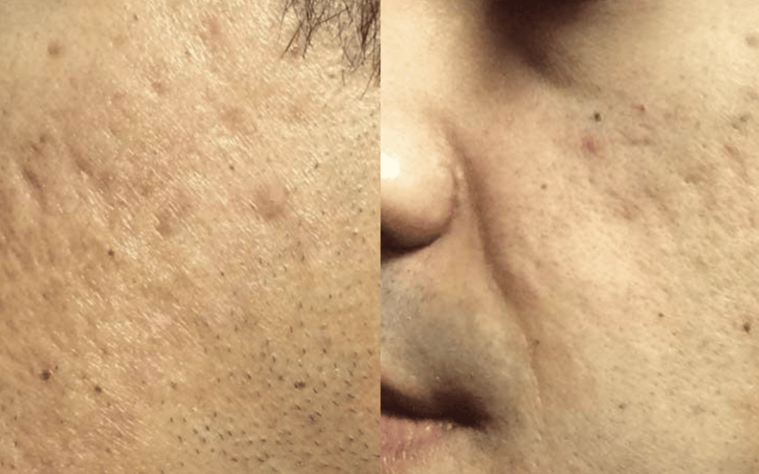 Secret PRO treatment to minimize acne scars