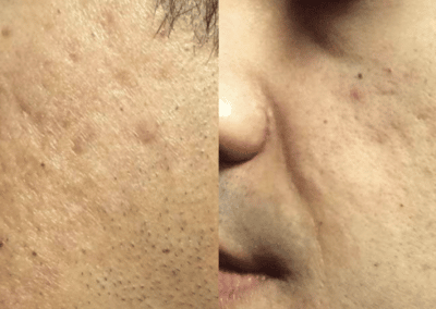 Secret PRO treatment to minimize acne scars