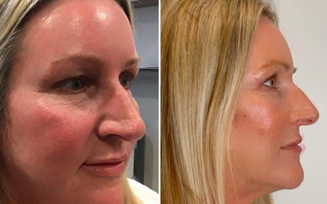 Lower Face Thread Lift and RHA Fillers Under the Eyes