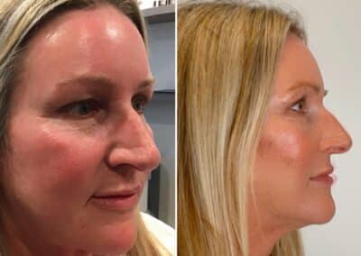 Lower Face Thread Lift and RHA Fillers Under the Eyes