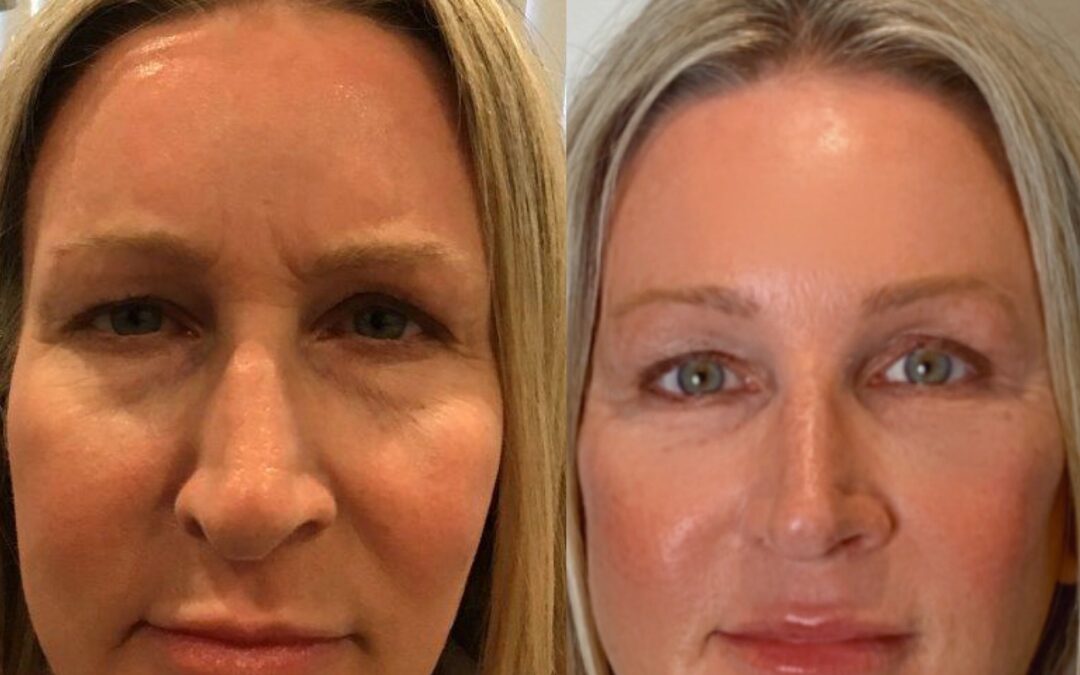 Lower Face Thread Lift and RHA Fillers Under the Eyes