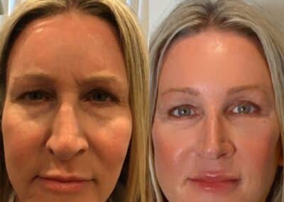 Lower Face Thread Lift and RHA Fillers Under the Eyes